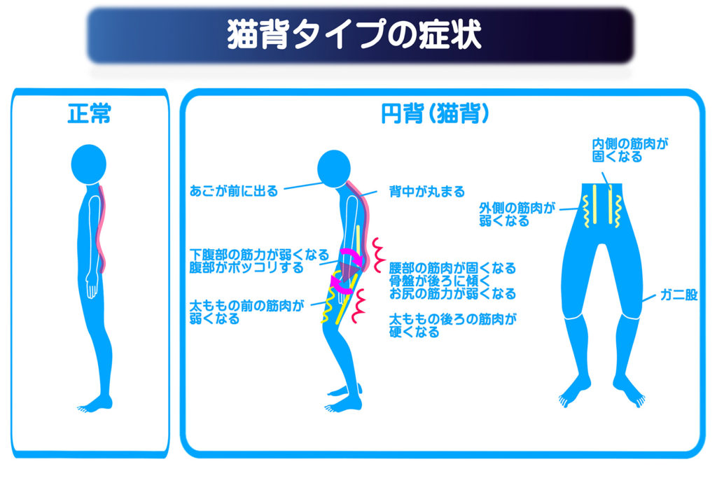 猫背矯正 | 佐賀市 なかしま鍼灸整骨院