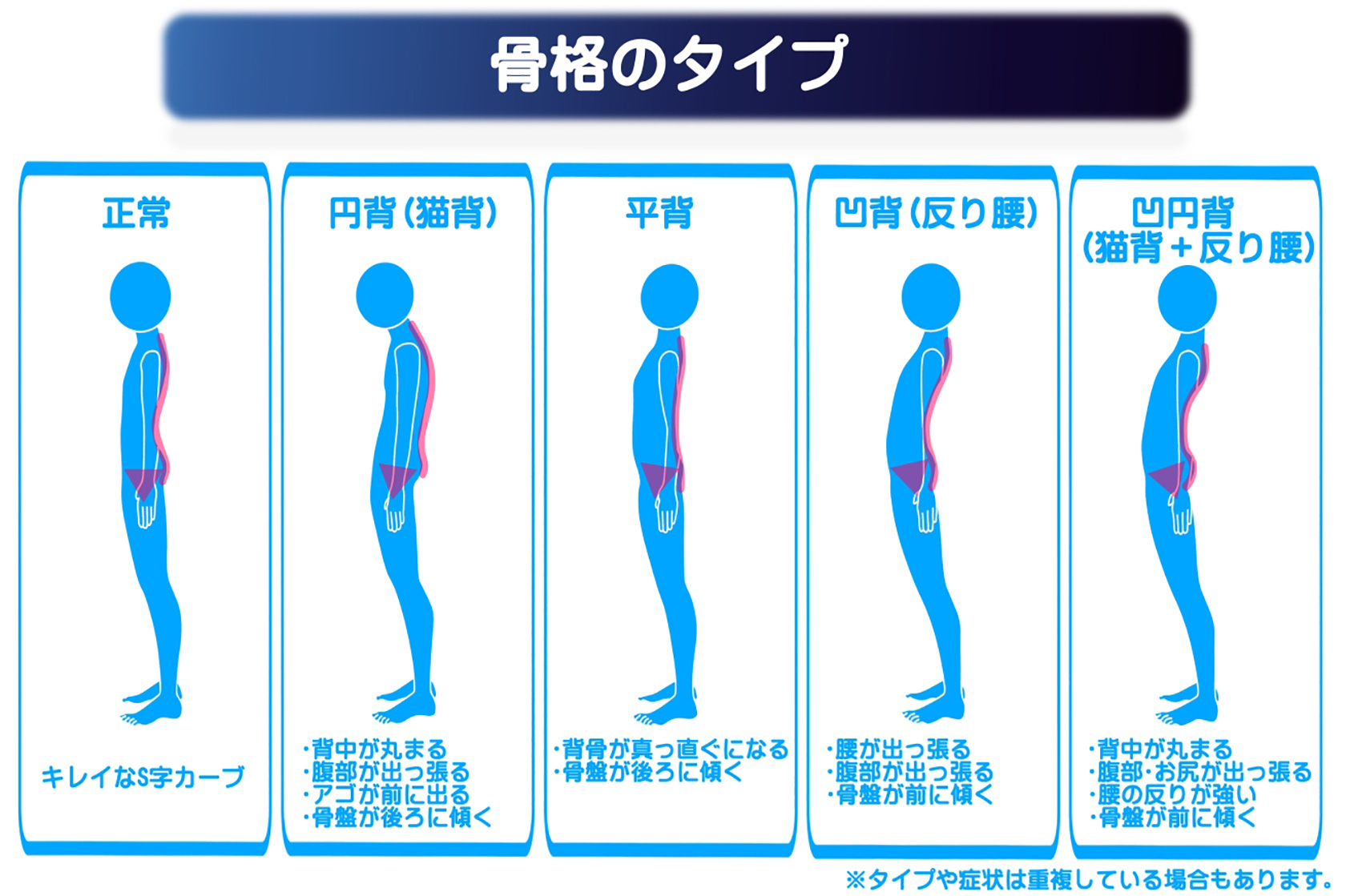 猫背矯正 | 佐賀市 なかしま鍼灸整骨院